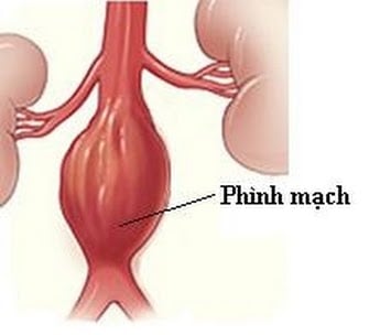 Phình động mạch đùi - Ảnh minh họa 3