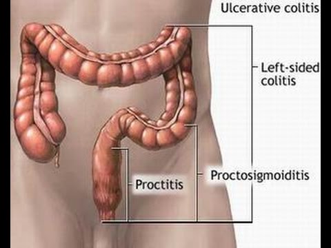 Proctitis - Ảnh minh họa 3