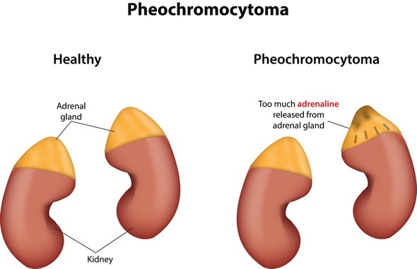 Pheochromocytoma - Ảnh minh họa 2