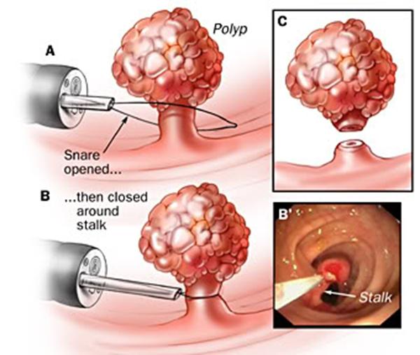 Polyp trực tràng - Ảnh minh họa 3