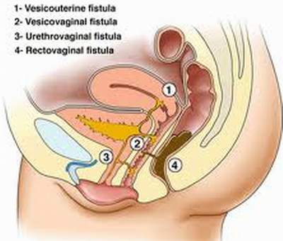 Peritonitis - Ảnh minh họa 2