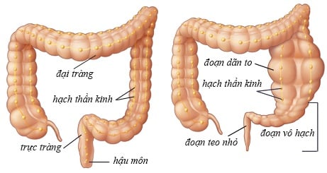 Phình đại tràng nhiễm độc - Ảnh minh họa 4