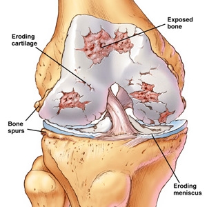 Pyogenic arthritis - Ảnh minh họa 2