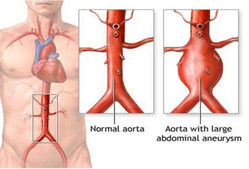 Phình bóc tách động mạch chủ - Ảnh minh họa 2