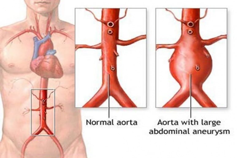 Phình động mạch chủ bụng - Ảnh minh họa 4