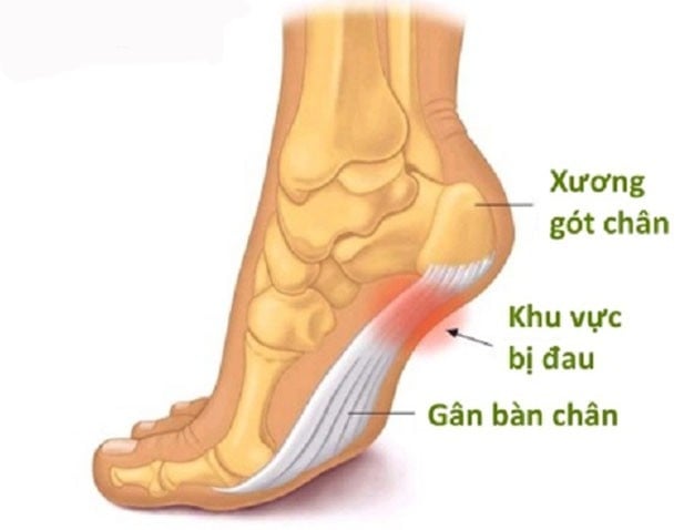 Plantar Fasciitis - Ảnh minh họa 2