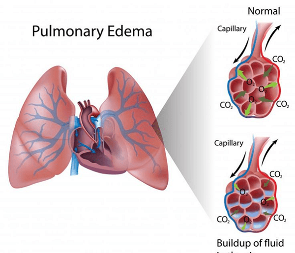 Phù phổi (Tràn dịch trong phổi) - Ảnh minh họa 4