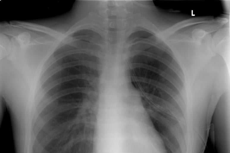 Pneumothorax - Ảnh minh họa 3