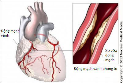 Bóc tách động mạch vành - Ảnh minh họa 1