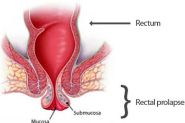 Prolapsus rectal - Ảnh minh họa 4