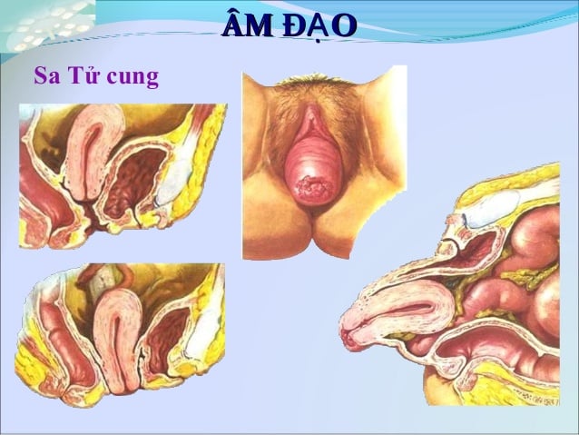 Prolapsed uterus - Ảnh minh họa 3