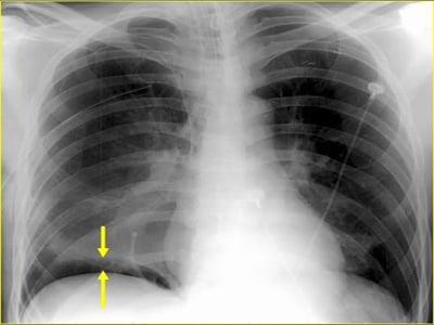 Pneumothorax - Ảnh minh họa 4