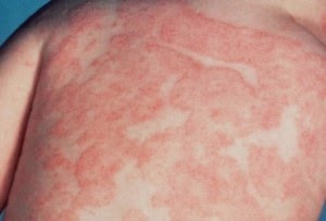 Pityriasis rosea - Ảnh minh họa 3