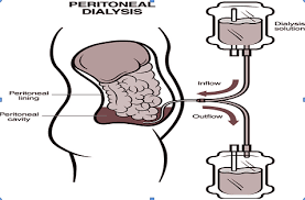 Peritonitis - Ảnh minh họa 3