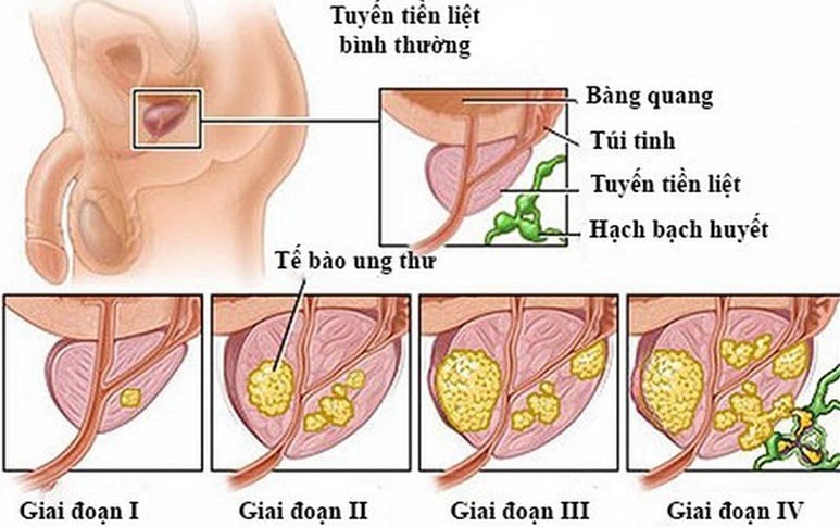 Prostate Cancer - Ảnh minh họa 3