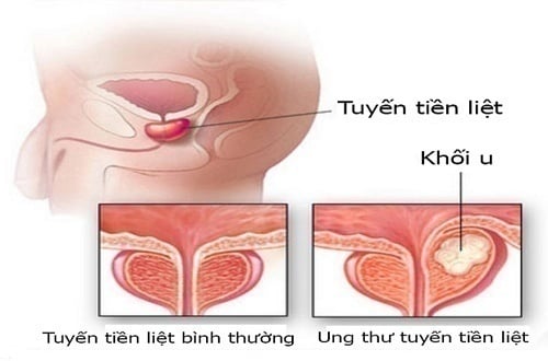 Prostate Cancer - Ảnh minh họa 4