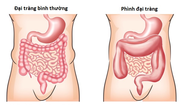 Phình đại tràng nhiễm độc - Ảnh minh họa 2