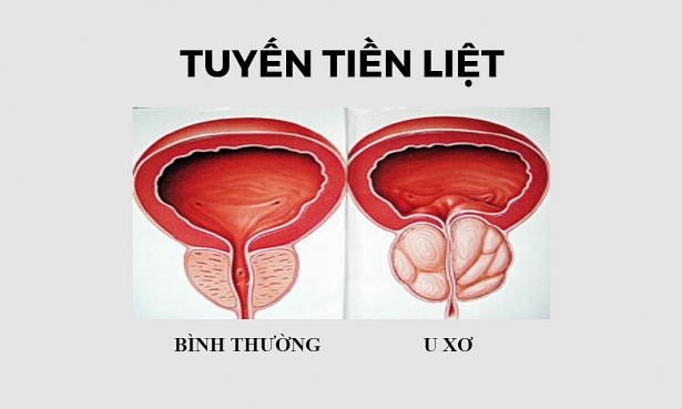 Benign prostatic hyperplasia - Ảnh minh họa 1