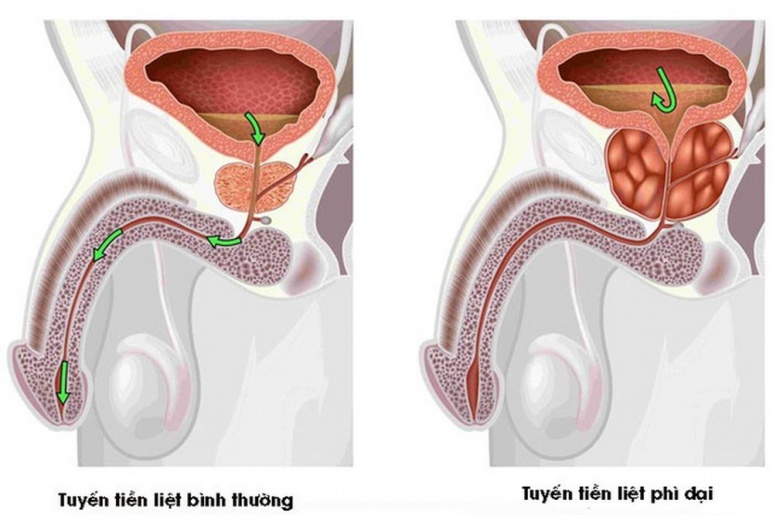 Benign prostatic hyperplasia - Ảnh minh họa 3