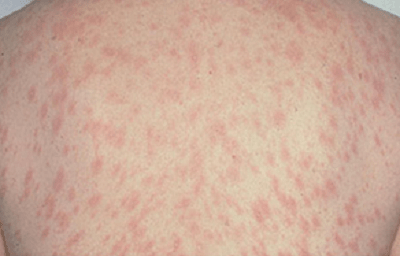 Pityriasis rosea - Ảnh minh họa 4