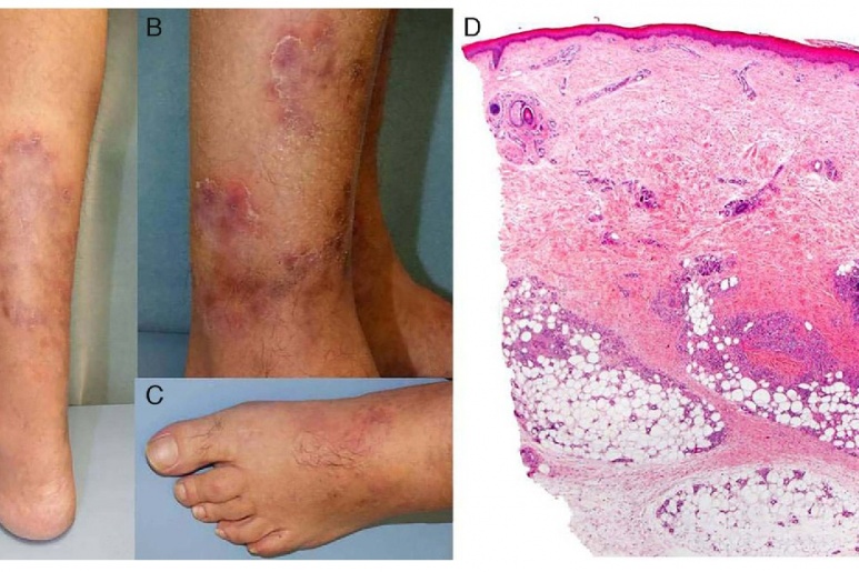 Polyarteritis nodosa - Ảnh minh họa 5