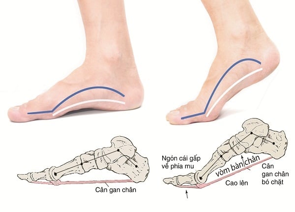 Plantar Fasciitis - Ảnh minh họa 4