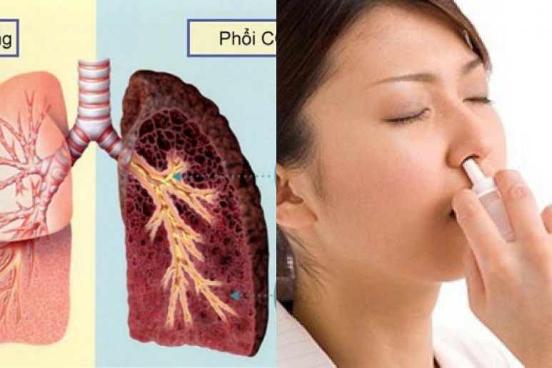 Bronchitis - Ảnh minh họa 3