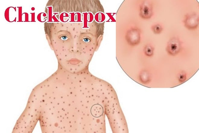 Chicken-pox - Ảnh minh họa 3