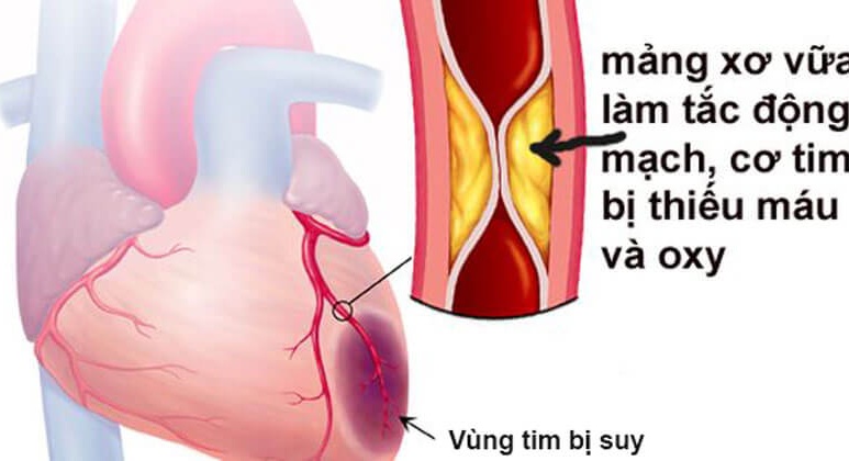 Coronary Artery Disease - Ảnh minh họa 3