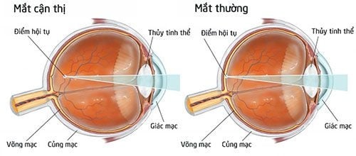 Cận thị - Ảnh minh họa 1