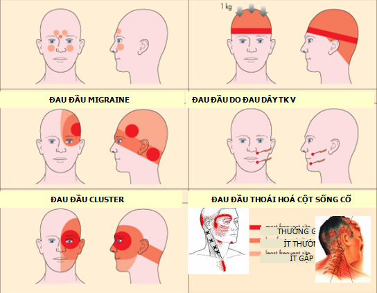 Chứng đau đầu - Ảnh minh họa 4