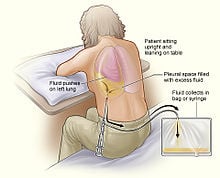 Pleuritis - Ảnh minh họa 1