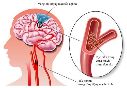 Rối loạn tuần hoàn não - Ảnh minh họa 2