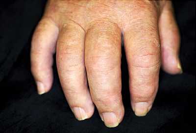 Psoriatic Arthritis - Ảnh minh họa 1