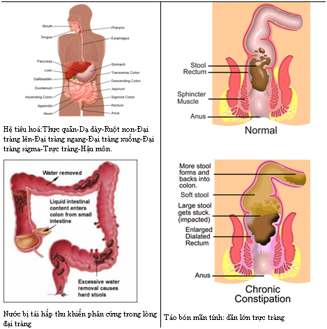 Phân khô cứng trong trực tràng - Ảnh minh họa 2