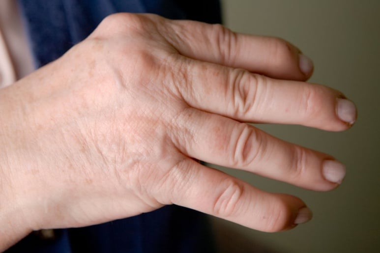 Psoriatic Arthritis - Ảnh minh họa 2