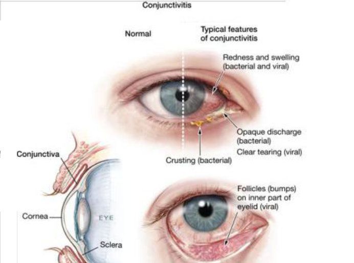 Conjunctivitis - Ảnh minh họa 1