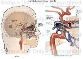 Carotid–Cavernous Fistula - Ảnh minh họa 4