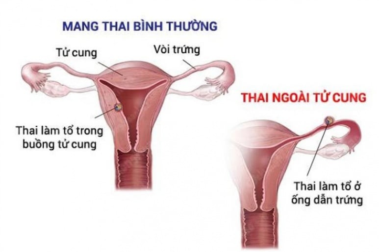 Chửa ngoài tử cung - Ảnh minh họa 1