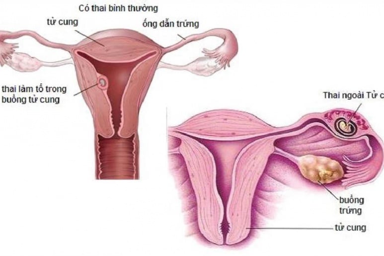 Chửa ngoài tử cung - Ảnh minh họa 2