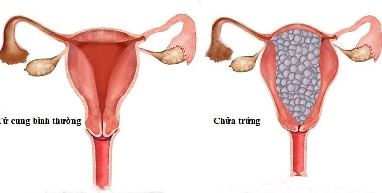 Chửa trứng - Ảnh minh họa 2