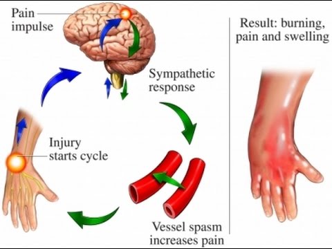 Complex regional pain syndrome - Ảnh minh họa 4