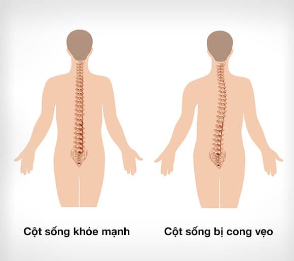 Cong vẹo cột sống - Ảnh minh họa 4