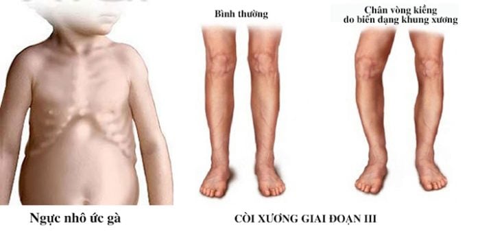 Còi xương - Ảnh minh họa 3