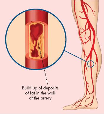 Peripheral arterial disease - Ảnh minh họa 3