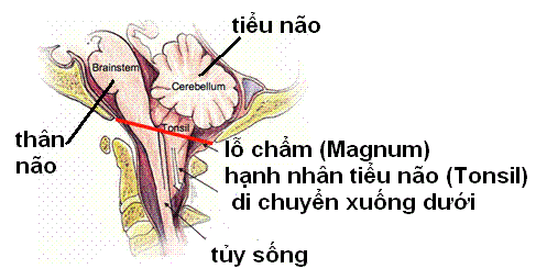 Chiari Malformation - Ảnh minh họa 2