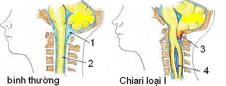 Chiari Malformation - Ảnh minh họa 3