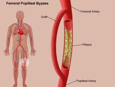 Peripheral arterial disease - Ảnh minh họa 2