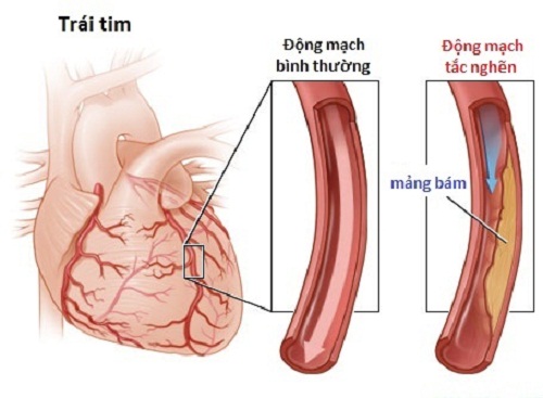 Peripheral arterial disease - Ảnh minh họa 1