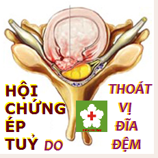 Chèn ép tủy - Ảnh minh họa 3